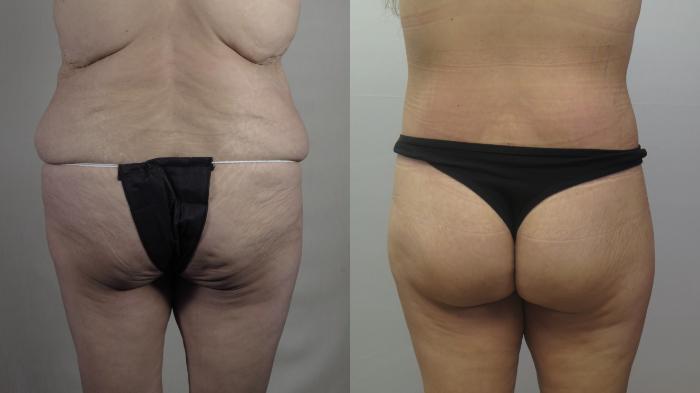 Body Lift Case 1585 Before & After Back | Paramus, New Jersey | Parker Center for Plastic Surgery