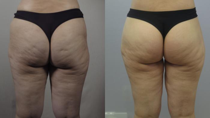 Body Lift Case 1606 Before & After Left Side | Paramus, New Jersey | Parker Center for Plastic Surgery