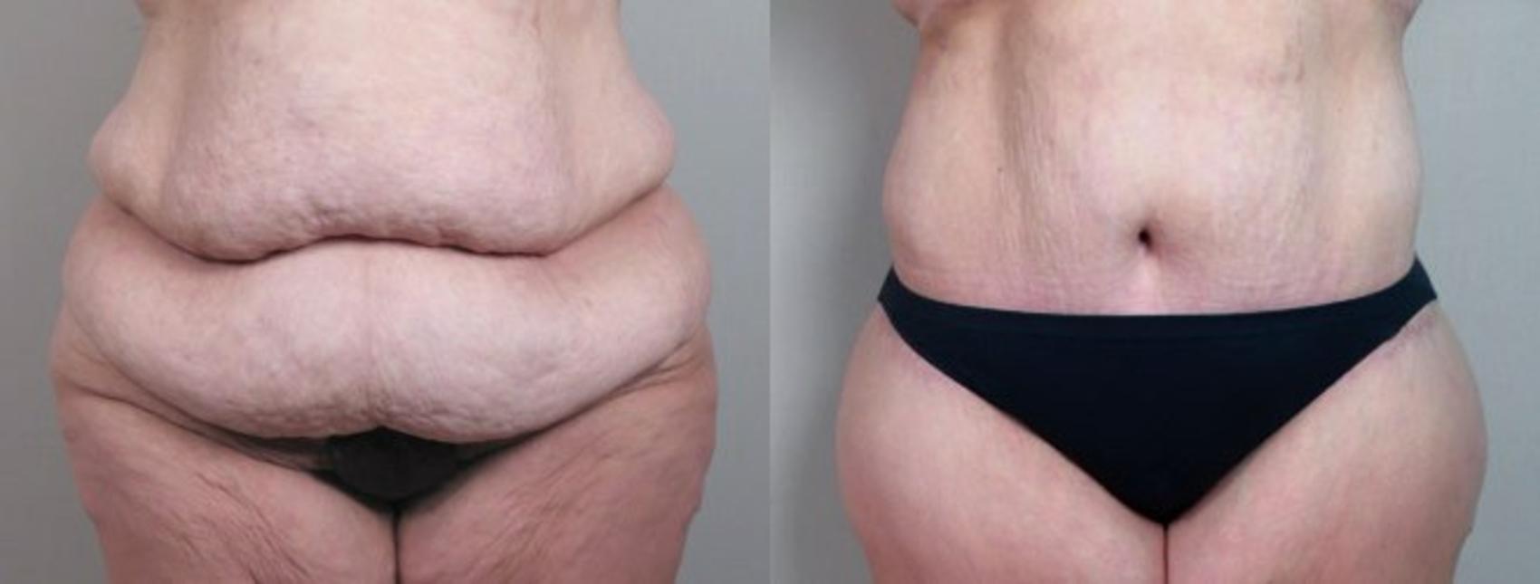 Body Lift Case 751 Before & After View #1 | Paramus, NJ | Parker Center for Plastic Surgery