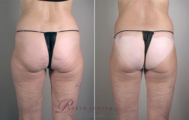 Body Lift Case 752 Before & After View #1 | Paramus, NJ | Parker Center for Plastic Surgery
