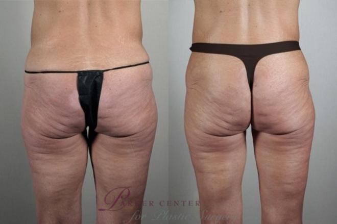 Body Lift Case 921 Before & After View #5 | Paramus, NJ | Parker Center for Plastic Surgery
