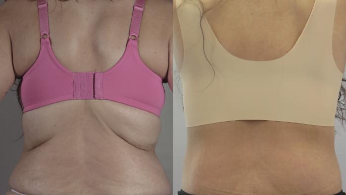 Bra Line Back Lift Case 1583 Before & After Back | Paramus, New Jersey | Parker Center for Plastic Surgery