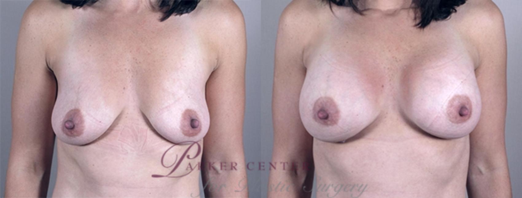 Breast Case 856 Before & After View #1 | Paramus, NJ | Parker Center for Plastic Surgery