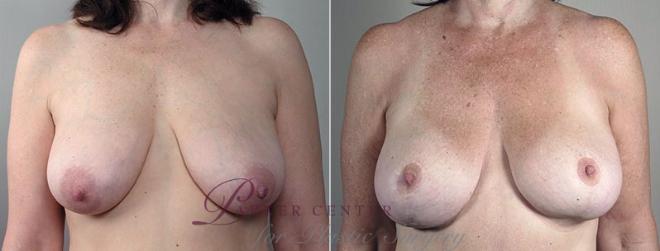 Breast Asymmetry Case 501 Before & After View #1 | Paramus, NJ | Parker Center for Plastic Surgery