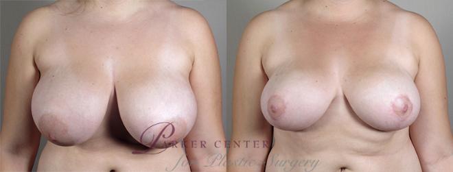 Breast Reduction Case 514 Before & After View #1 | Paramus, NJ | Parker Center for Plastic Surgery
