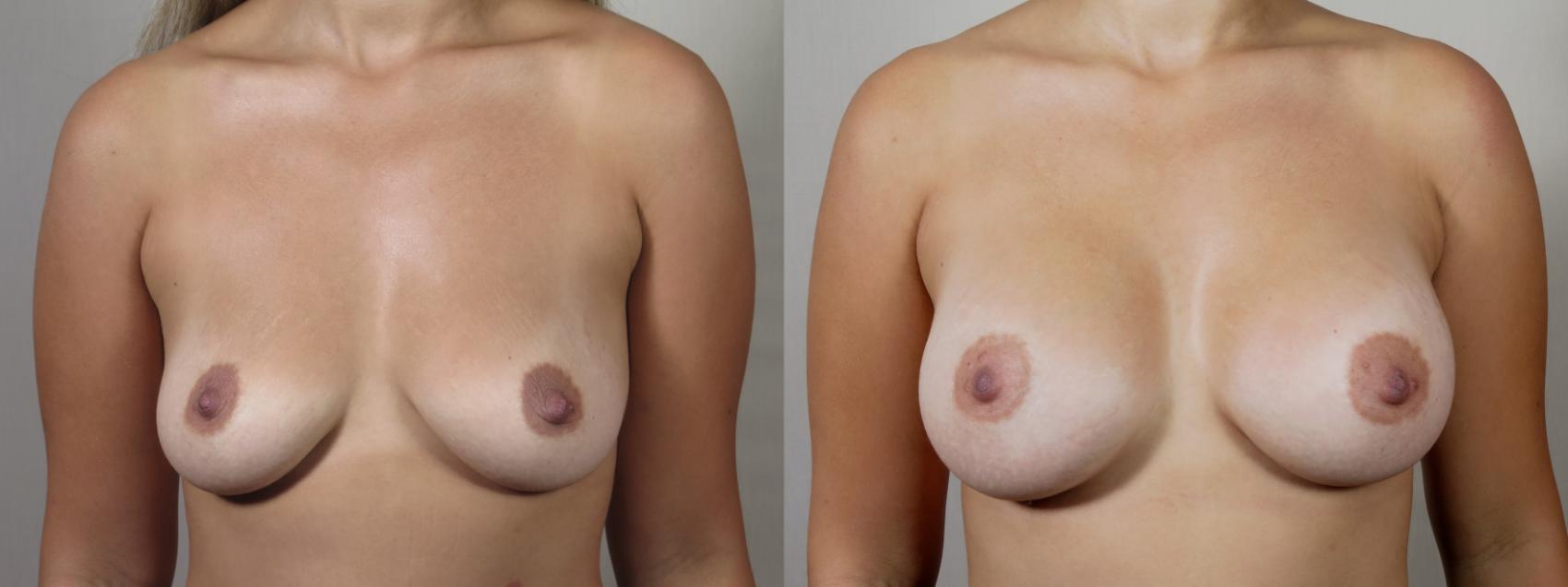 Breast Augmentation Case 1575 Before & After Front | Paramus, New Jersey | Parker Center for Plastic Surgery