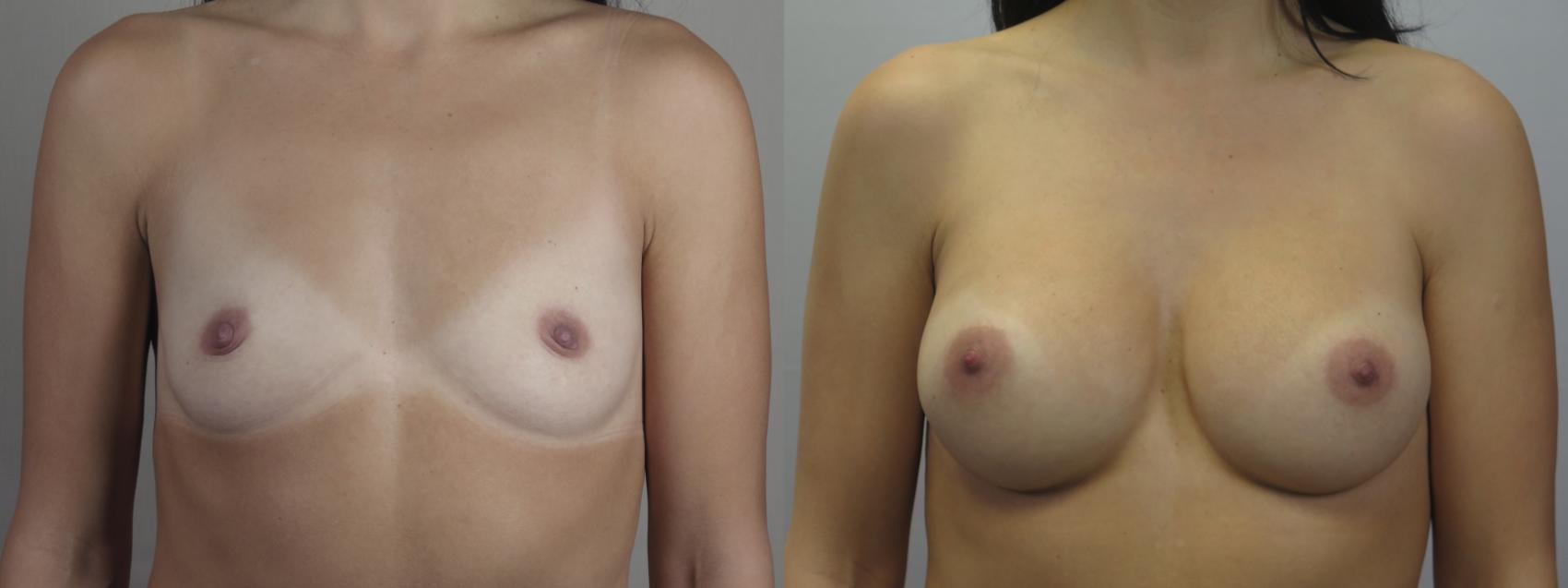 Breast Augmentation Case 1576 Before & After Front | Paramus, New Jersey | Parker Center for Plastic Surgery