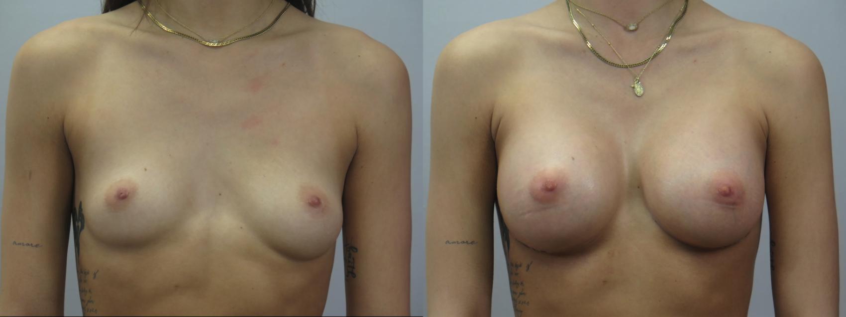 Breast Augmentation Case 1577 Before & After Front | Paramus, New Jersey | Parker Center for Plastic Surgery