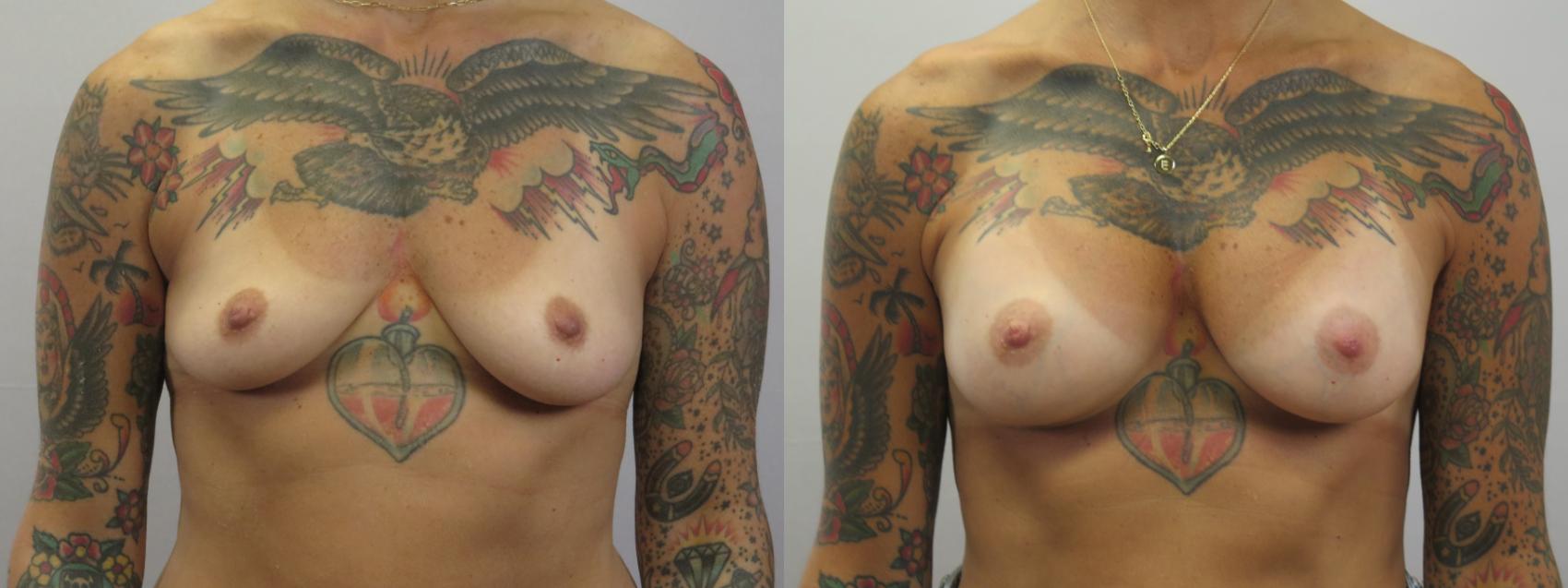 Breast Augmentation Case 1624 Before & After Front | Paramus, New Jersey | Parker Center for Plastic Surgery