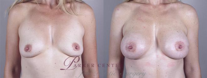 Breast Augmentation Case 376 Before & After View #1 | Paramus, NJ | Parker Center for Plastic Surgery