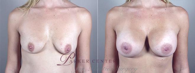 Breast Augmentation Case 381 Before & After View #1 | Paramus, NJ | Parker Center for Plastic Surgery
