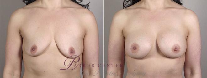 Breast Augmentation Case 407 Before & After View #1 | Paramus, NJ | Parker Center for Plastic Surgery