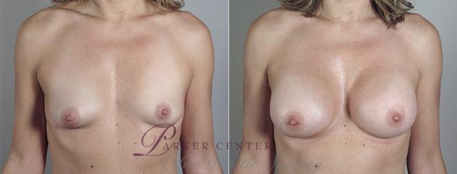Mommy Makeover Case 426 Before & After View #1 | Paramus, NJ | Parker Center for Plastic Surgery