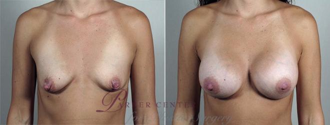 Nipple Procedures Case 429 Before & After View #1 | Paramus, NJ | Parker Center for Plastic Surgery