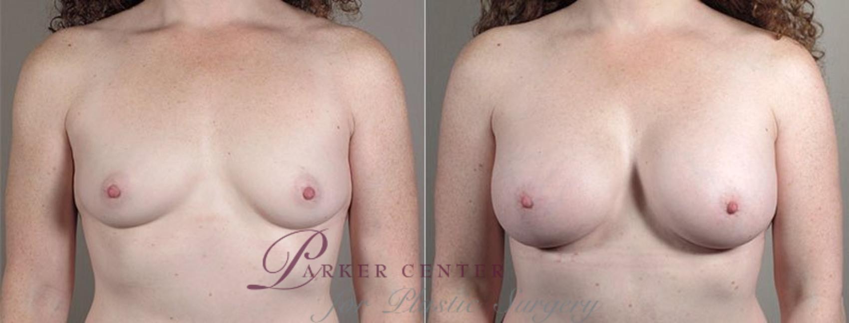 Breast Augmentation Case 440 Before & After View #1 | Paramus, NJ | Parker Center for Plastic Surgery