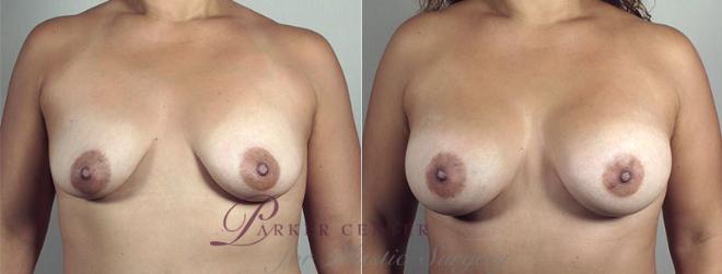 Breast Augmentation Case 443 Before & After View #5 | Paramus, NJ | Parker Center for Plastic Surgery