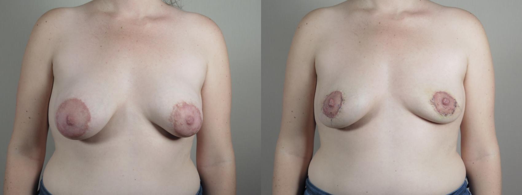 Breast Implant Removal Case 1009 Before & After Front | Paramus, NJ | Parker Center for Plastic Surgery