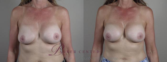 Breast Implant Revision Case 1226 Before & After View #1  | Paramus, NJ | Parker Center for Plastic Surgery