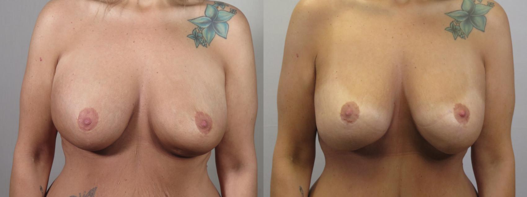 Breast Implant Revision Case 1589 Before & After Front | Paramus, New Jersey | Parker Center for Plastic Surgery
