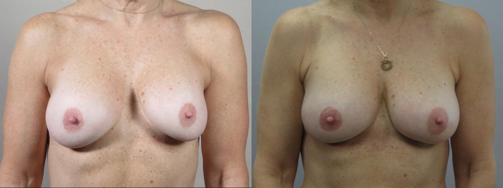 Breast Implant Revision Case 1615 Before & After Front | Paramus, New Jersey | Parker Center for Plastic Surgery