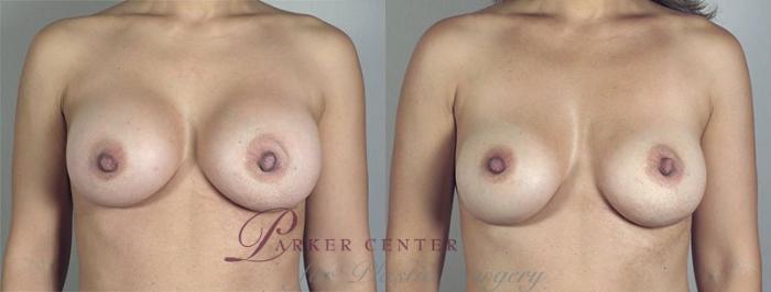 Breast Implant Revision Case 517 Before & After View #1 | Paramus, NJ | Parker Center for Plastic Surgery