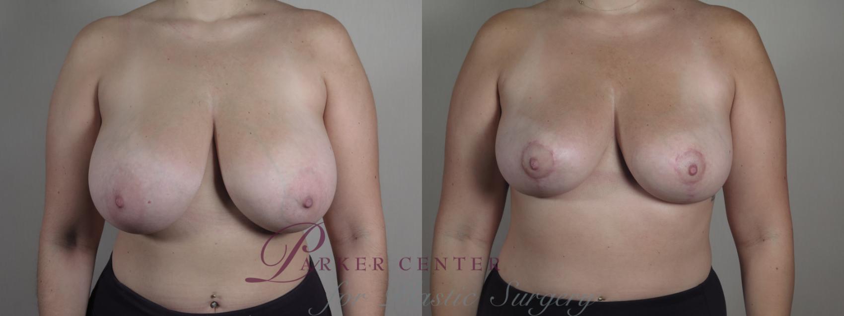 Breast Lift Case 1330 Before & After Front | Paramus, NJ | Parker Center for Plastic Surgery