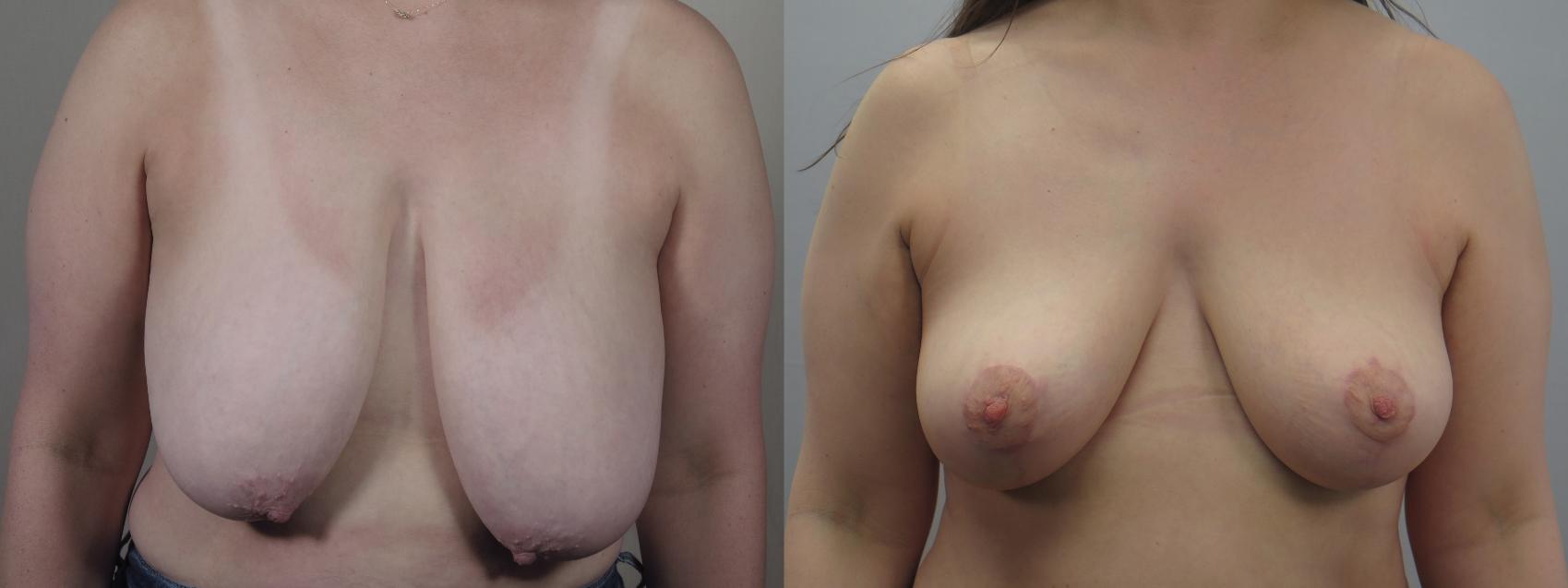 Breast Lift Case 1552 Before & After Front | Paramus, New Jersey | Parker Center for Plastic Surgery