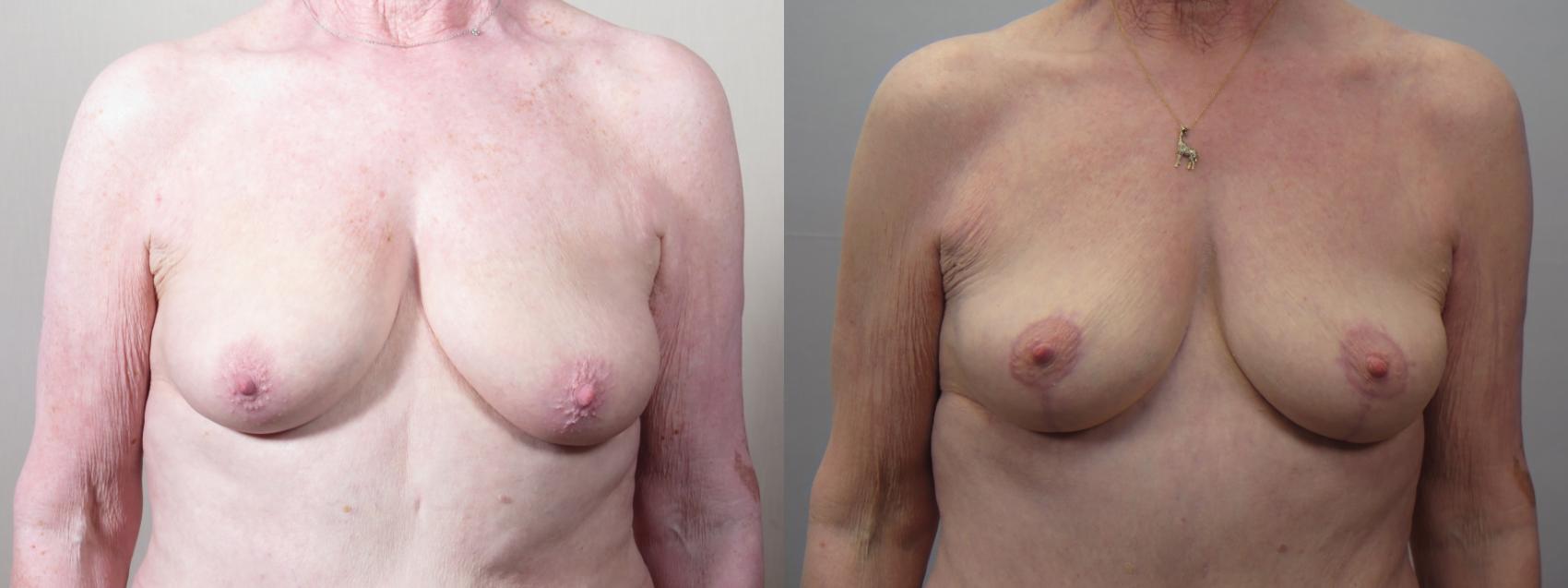 Breast Lift Case 1559 Before & After Front | Paramus, New Jersey | Parker Center for Plastic Surgery