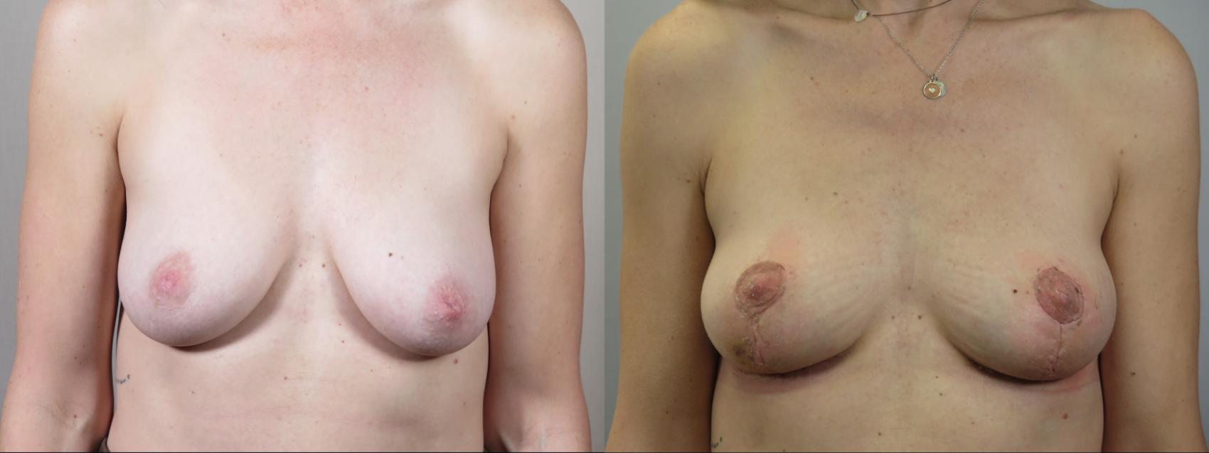 Breast Lift Case 1568 Before & After Front | Paramus, New Jersey | Parker Center for Plastic Surgery