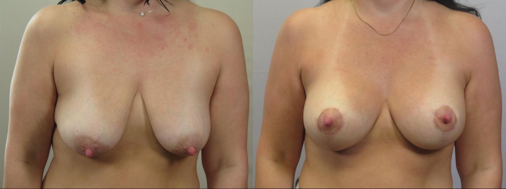 Breast Lift Case 1586 Before & After Front | Paramus, New Jersey | Parker Center for Plastic Surgery