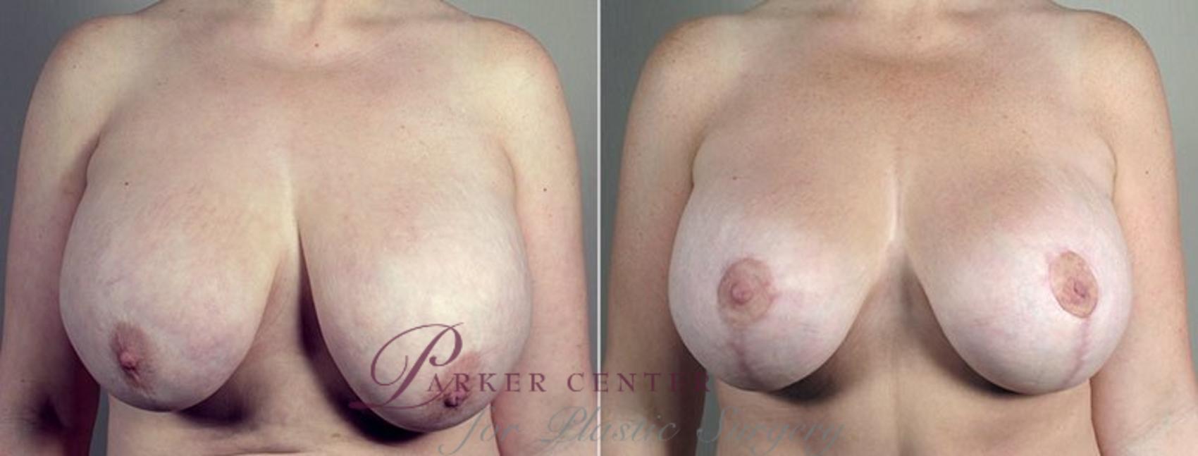 Breast Lift Case 553 Before & After View #1 | Paramus, NJ | Parker Center for Plastic Surgery