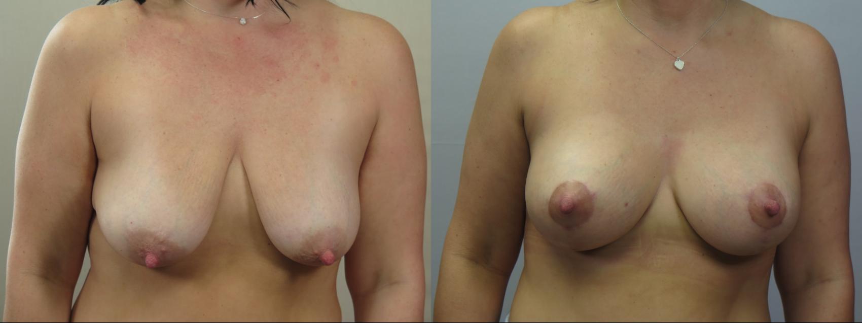Breast Lift with Implants Case 1553 Before & After Front | Paramus, New Jersey | Parker Center for Plastic Surgery