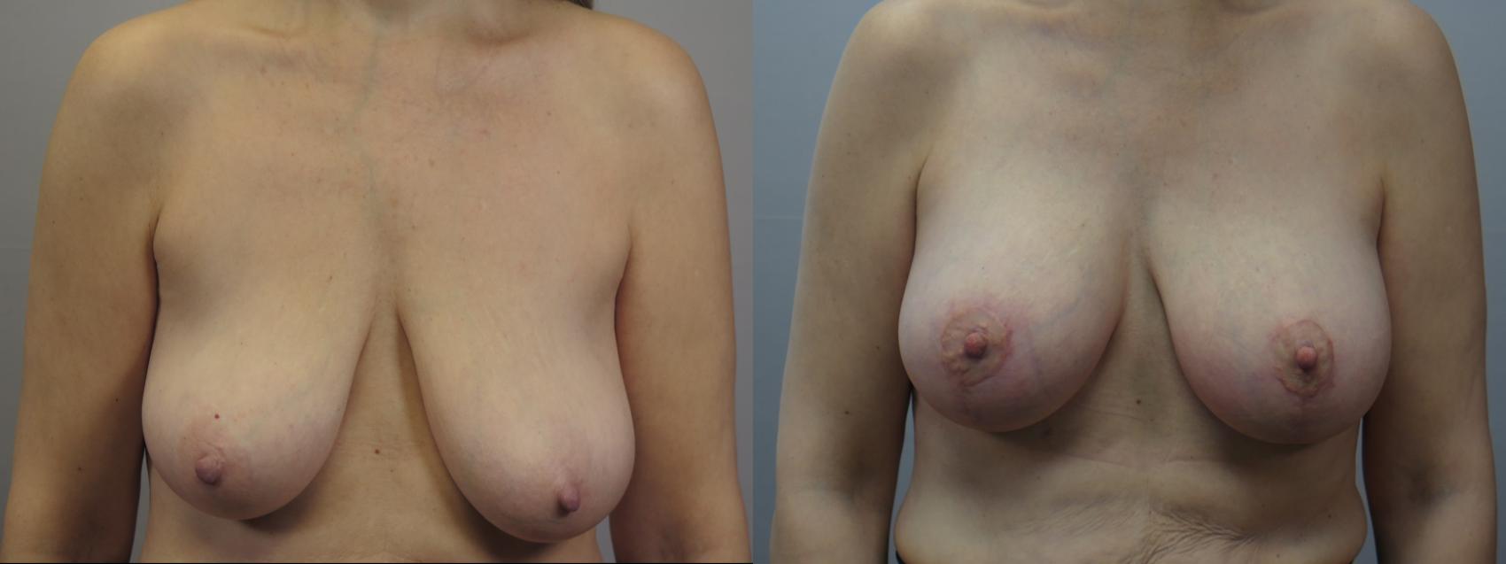 Breast Lift with Implants Case 1614 Before & After Front | Paramus, New Jersey | Parker Center for Plastic Surgery