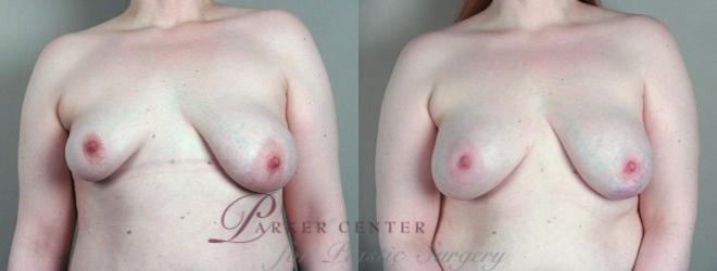 Breast Lift with Implants Case 447 Before & After View #1 | Paramus, NJ | Parker Center for Plastic Surgery