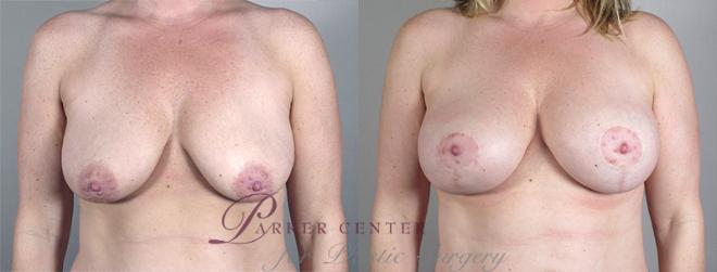 Breast Lift with Implants Case 461 Before & After View #1 | Paramus, NJ | Parker Center for Plastic Surgery