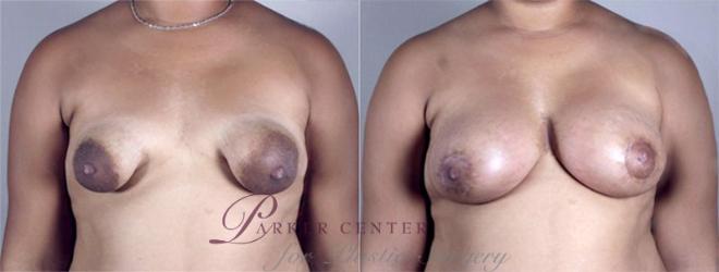 Breast Lift with Implants Case 465 Before & After View #1 | Paramus, NJ | Parker Center for Plastic Surgery