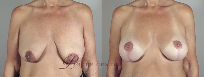Breast Lift with Implants Case 467 Before & After View #1 | Paramus, NJ | Parker Center for Plastic Surgery