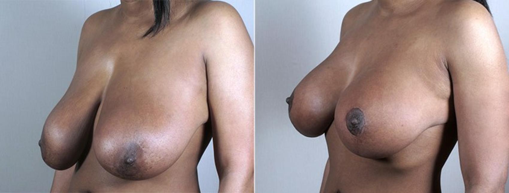 Breast Lift with Implants Case 489 Before & After View #1 | Paramus, NJ | Parker Center for Plastic Surgery