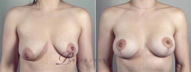 Breast Lift with Implants Case 490 Before & After View #1 | Paramus, NJ | Parker Center for Plastic Surgery