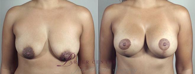 Breast Lift with Implants Case 496 Before & After View #1 | Paramus, NJ | Parker Center for Plastic Surgery