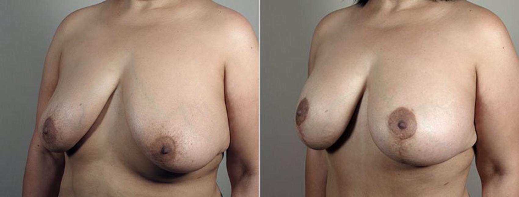 Breast Lift with Implants Case 499 Before & After View #1 | Paramus, NJ | Parker Center for Plastic Surgery