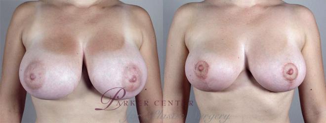 Breast Reduction Case 529 Before & After View #1 | Paramus, NJ | Parker Center for Plastic Surgery