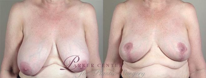 Breast Reduction Case 538 Before & After View #1 | Paramus, NJ | Parker Center for Plastic Surgery