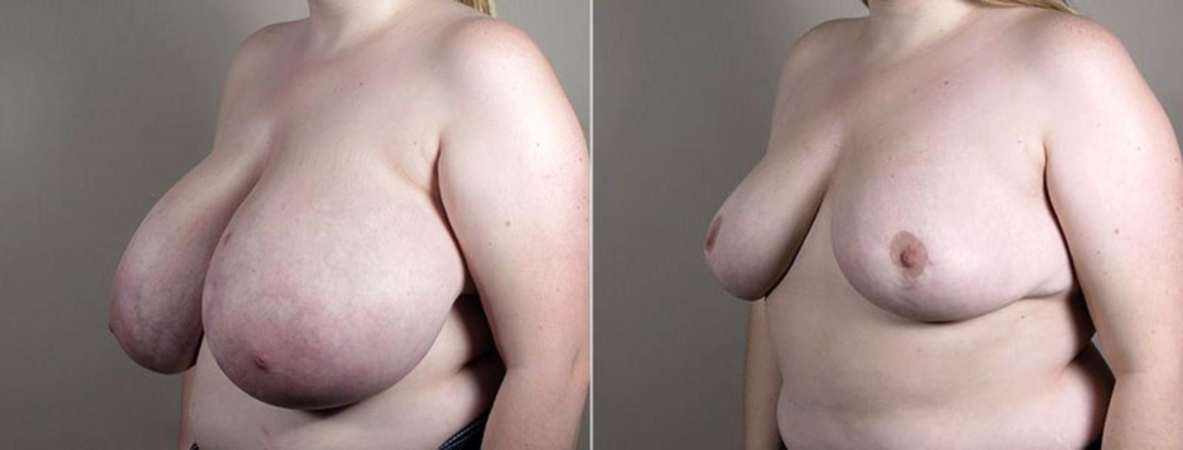 Breast Reduction Case 540 Before & After View #1 | Paramus, NJ | Parker Center for Plastic Surgery