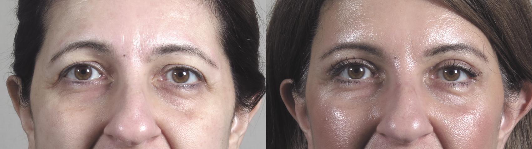 Brow Lift Case 1442 Before & After Front | Paramus, New Jersey | Parker Center for Plastic Surgery