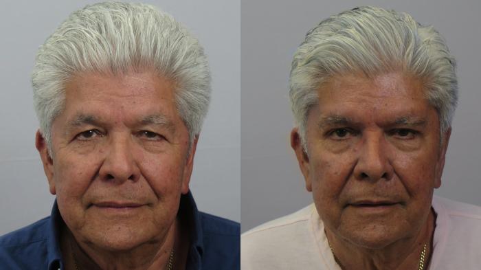 Brow Lift Case 1609 Before & After Front | Paramus, New Jersey | Parker Center for Plastic Surgery