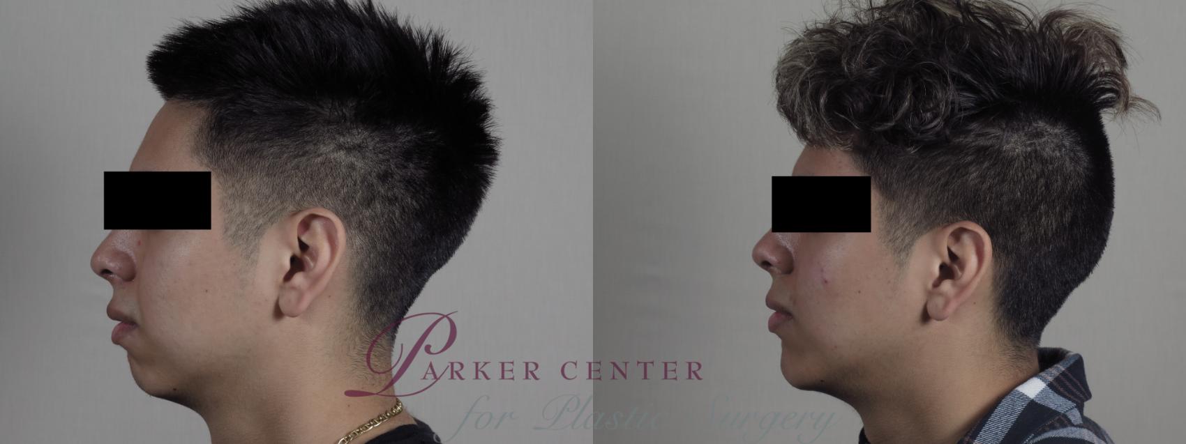 Cheek/Chin Implants Case 1207 Before & After View #1 | Paramus, NJ | Parker Center for Plastic Surgery