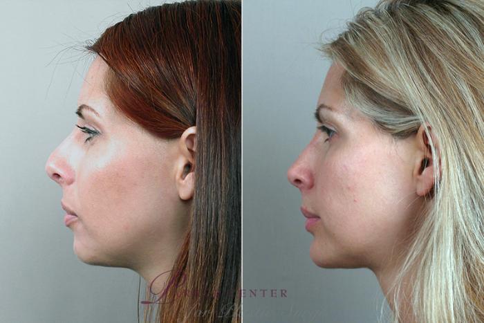 Rhinoplasty Case 125 Before & After View #2 | Paramus, NJ | Parker Center for Plastic Surgery