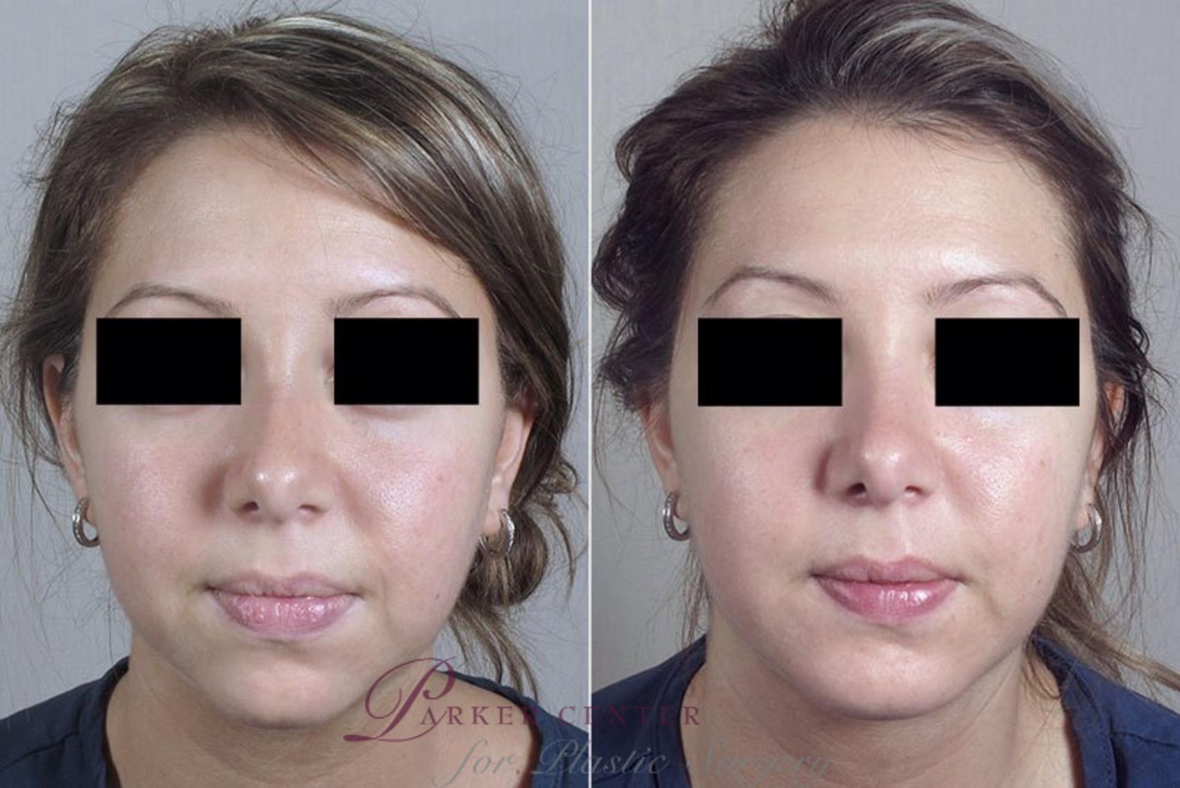 Cheek/Chin Implants Case 255 Before & After View #1 | Paramus, NJ | Parker Center for Plastic Surgery