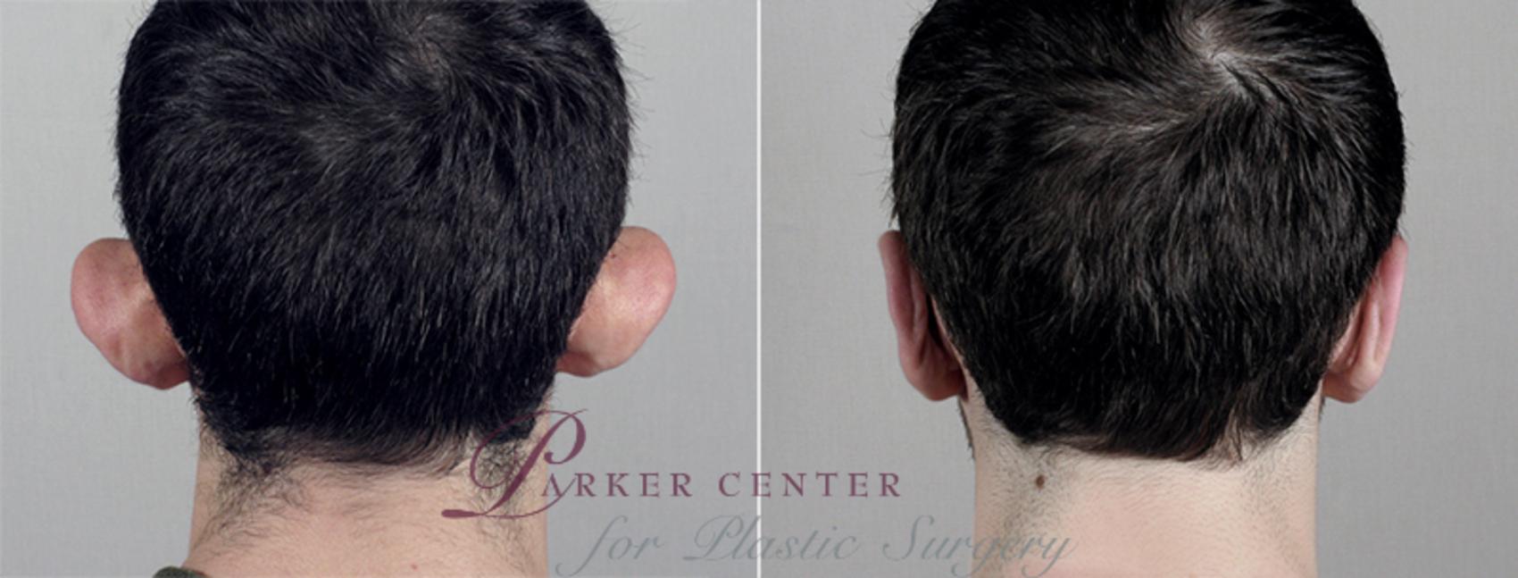 Ear Surgery Case 239 Before & After View #1 | Paramus, NJ | Parker Center for Plastic Surgery